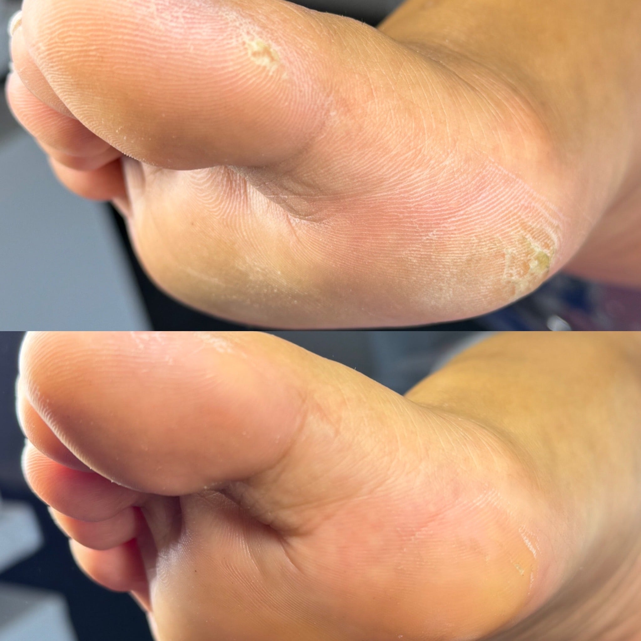 Luxury dry e-file pedicure with satisfying before & after callus removal results