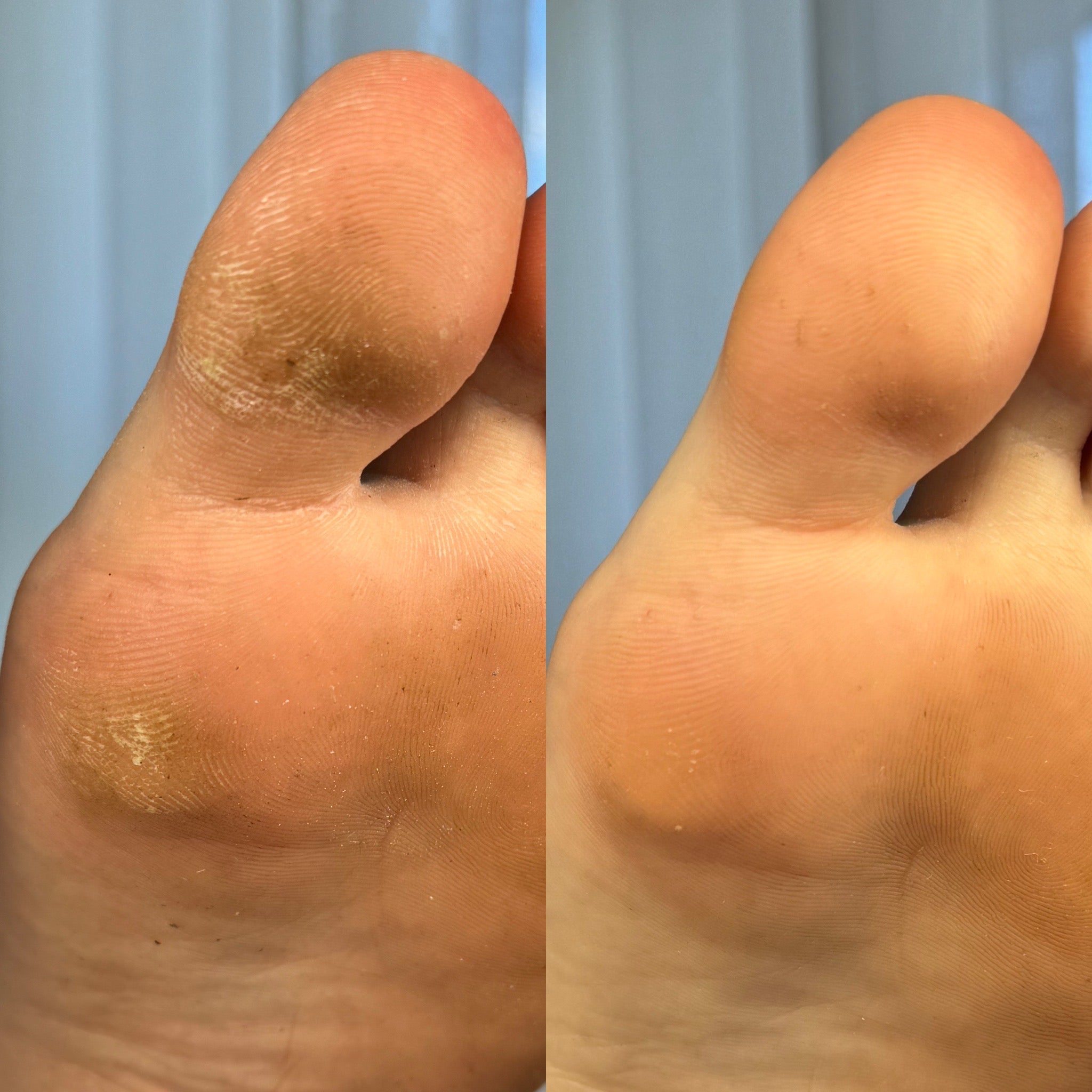 Luxury dry e-file pedicure with satisfying before & after callus removal results