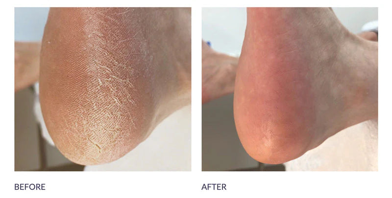 Ultimate At Home Foot Care Combo