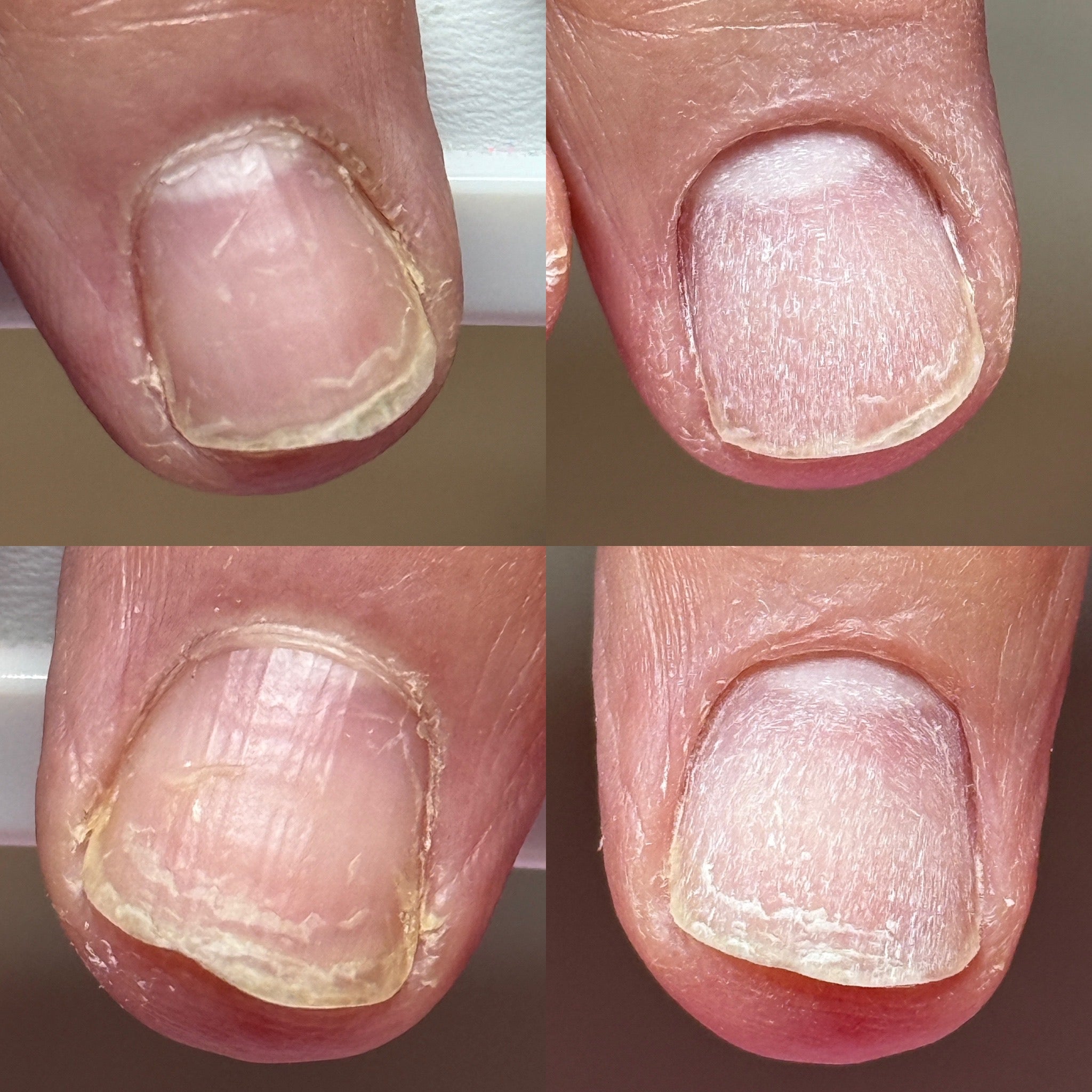 Clients finger before & after a high quality e-file manicure.